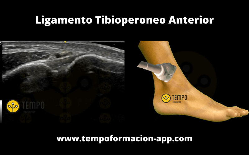 Ligamento Tibioperoneo Anterior Sonda Ecografía.png